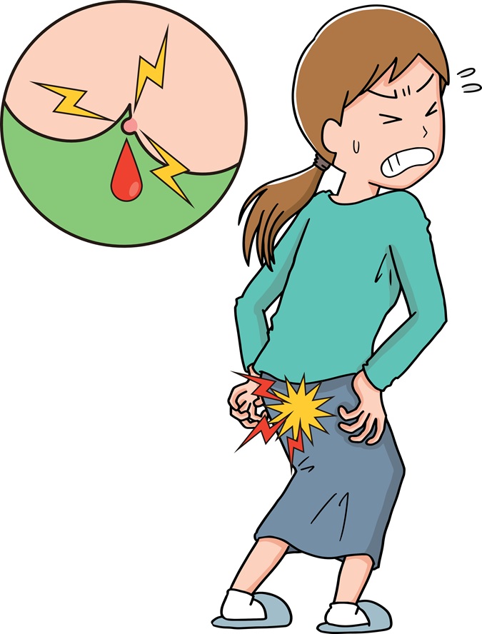 いぼ痔で悩む女性